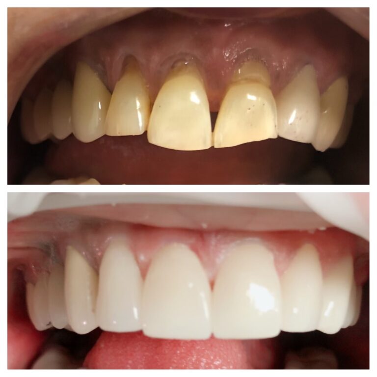 Before and After Photos Nuva Dental