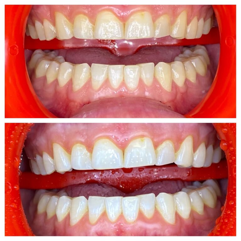 Before and After Photos Nuva Dental