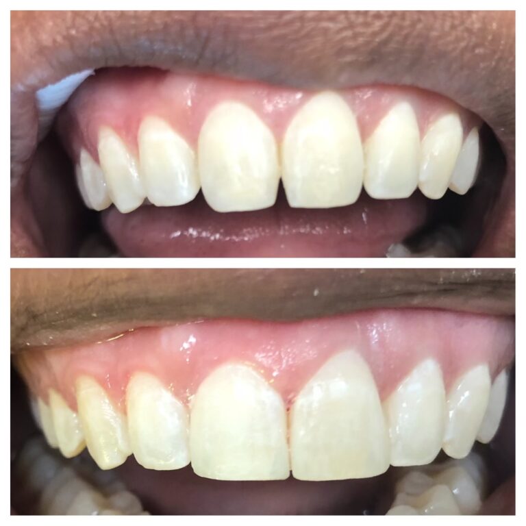 Before and After Photos Nuva Dental