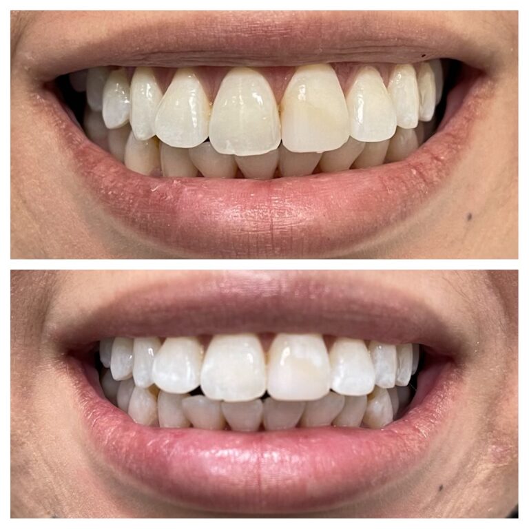 Before and After Photos Nuva Dental