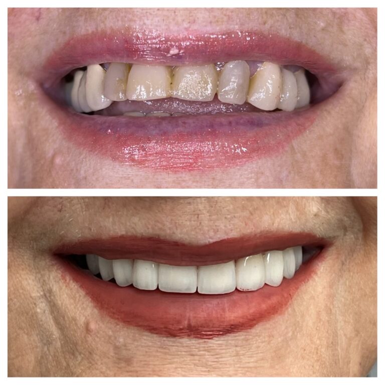 Before and After Photos Nuva Dental