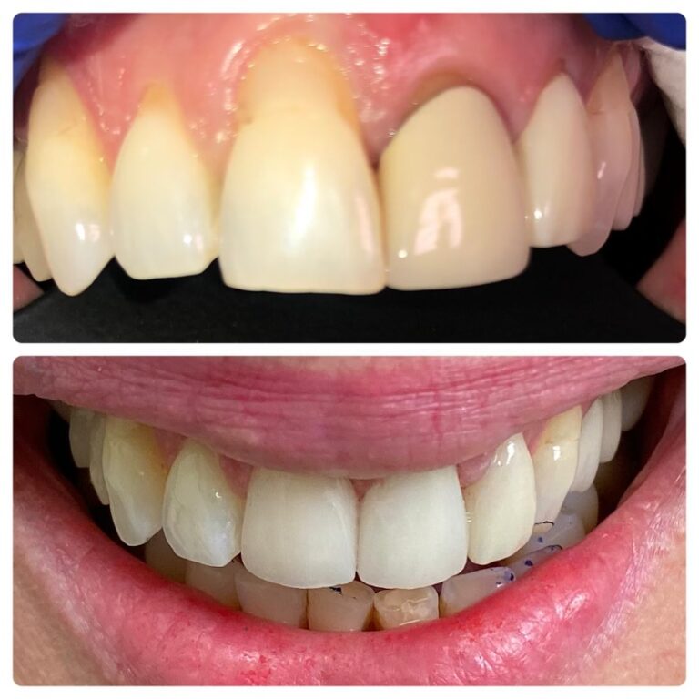 Before and After Photos Nuva Dental