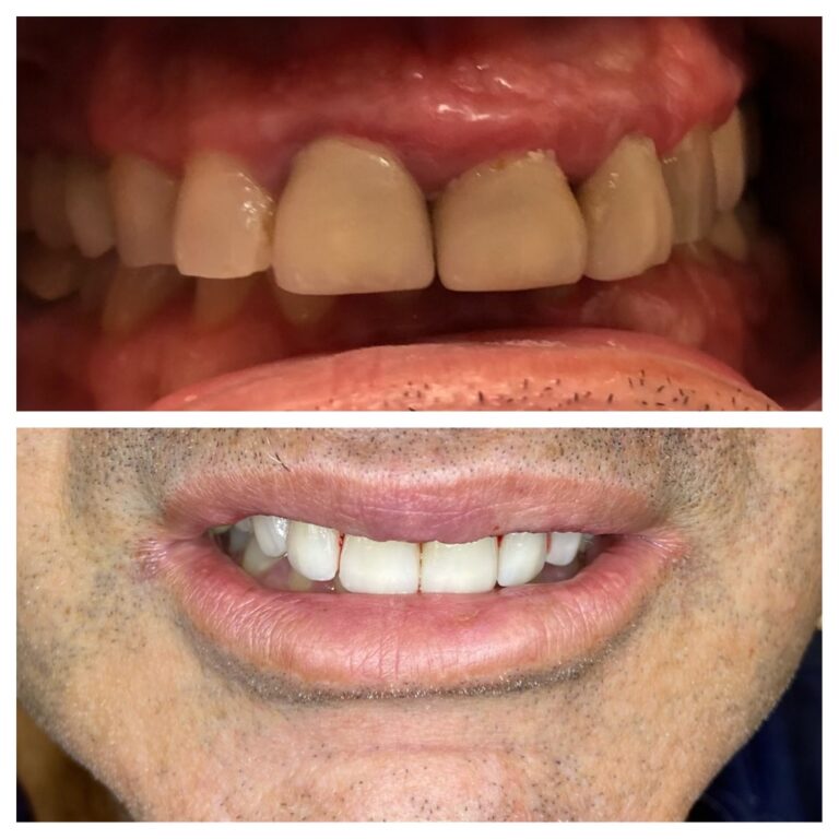 Before and After Photos Nuva Dental