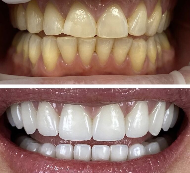 Before and After Photos Nuva Dental