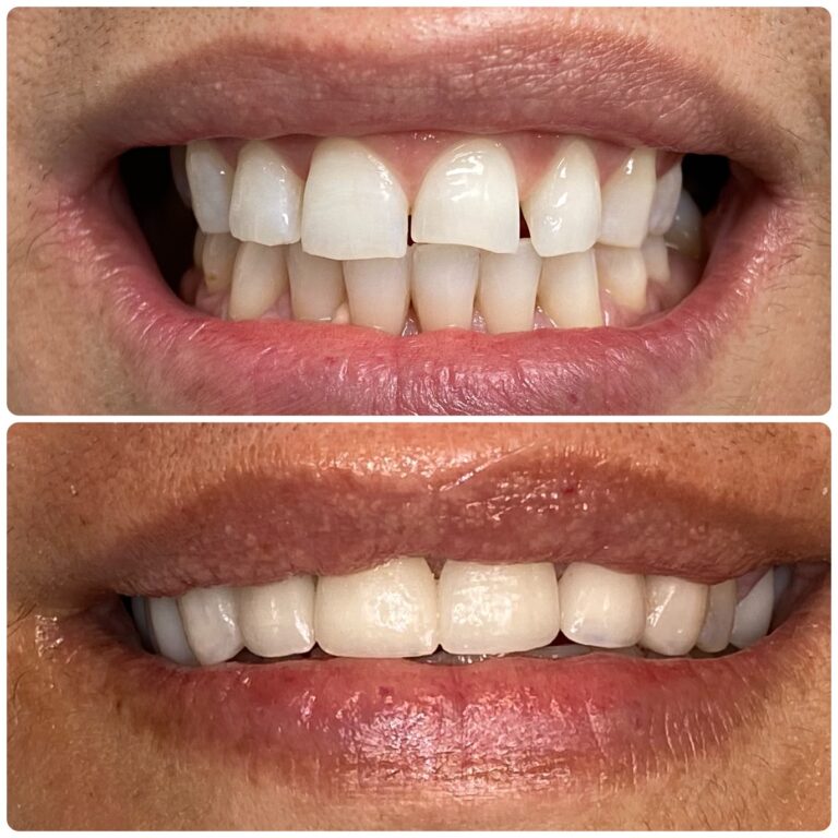 Before and After Photos Nuva Dental