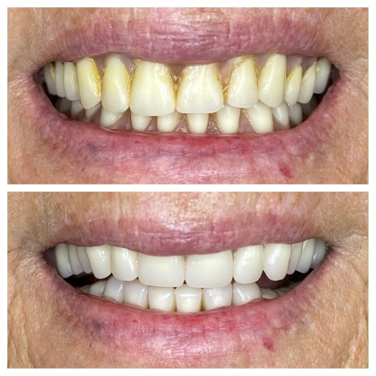 Before and After Photos Nuva Dental