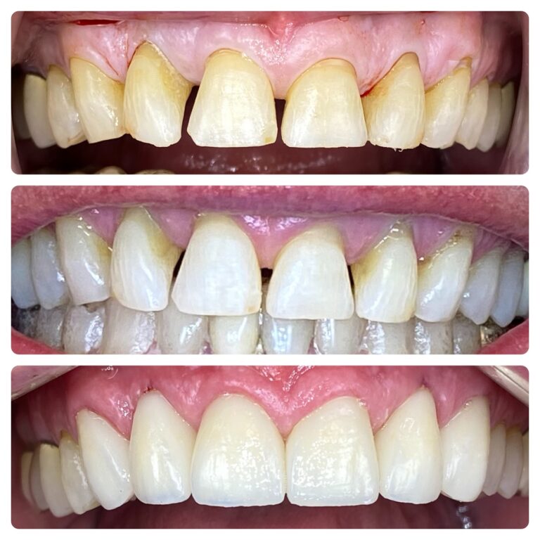 Before and After Photos Nuva Dental