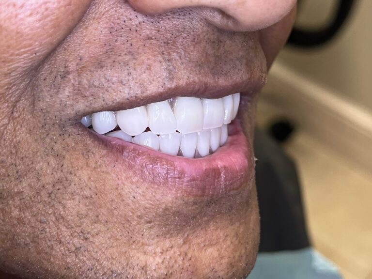 Before and After Photos Nuva Dental