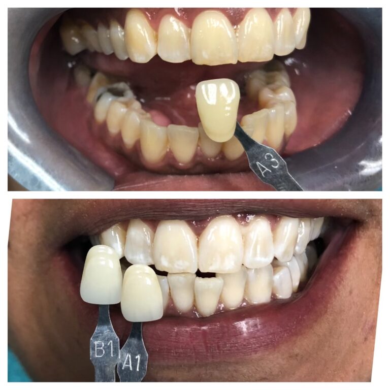 Before and After Photos Nuva Dental