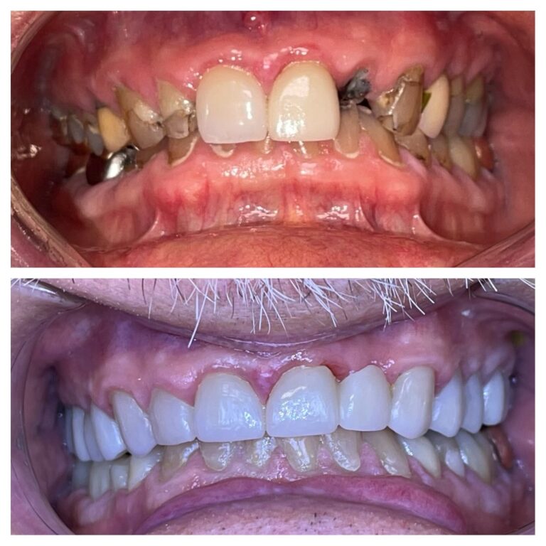 Before and After Photos Nuva Dental