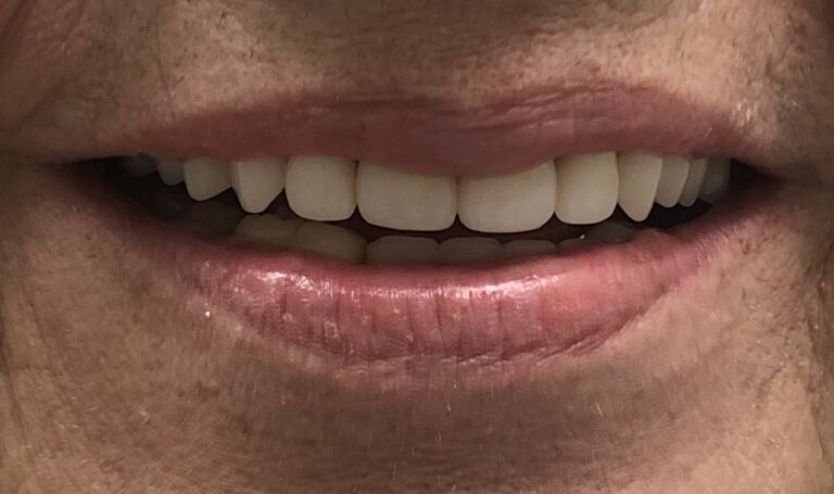 Before and After Photos Nuva Dental