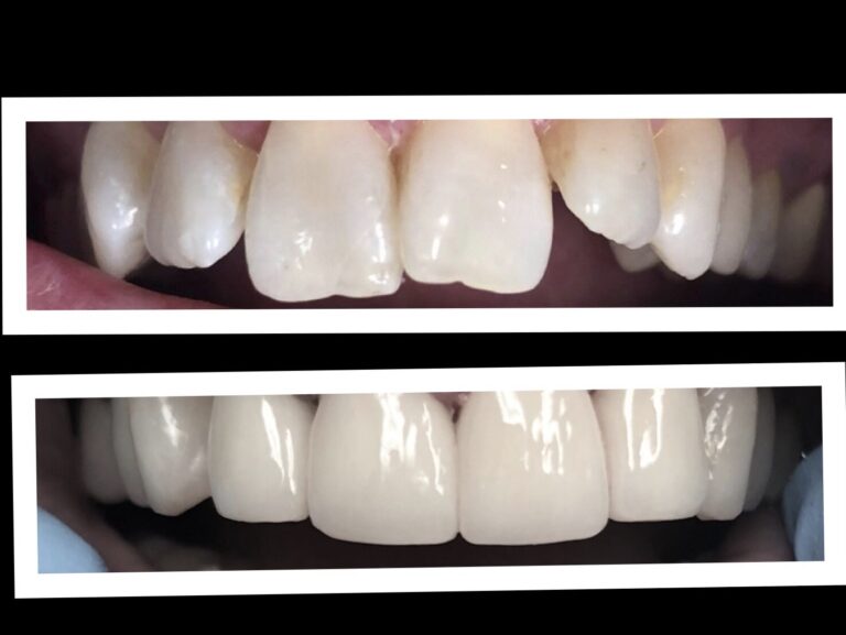 Before and After Photos Nuva Dental