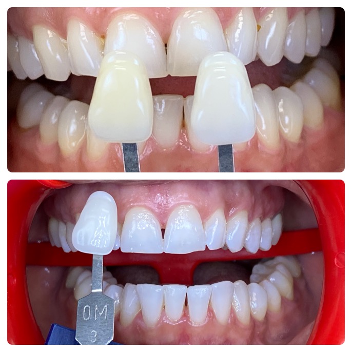 Before and After Photos Nuva Dental