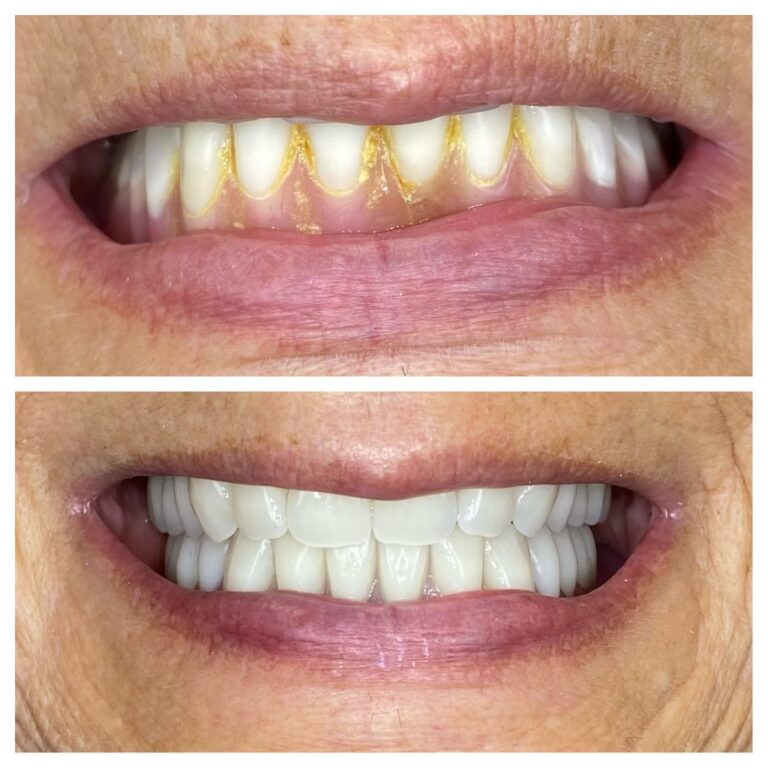 Before and After Photos Nuva Dental