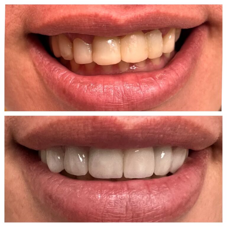 Before and After Photos Nuva Dental