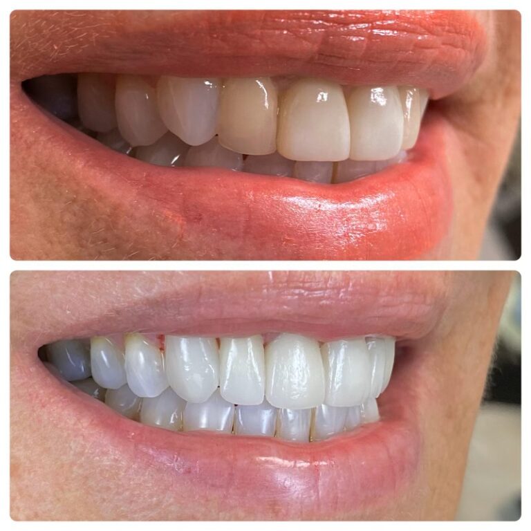 Before and After Photos Nuva Dental