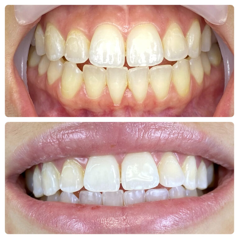 Before and After Photos Nuva Dental