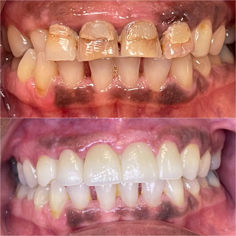 Before and After Photos Nuva Dental