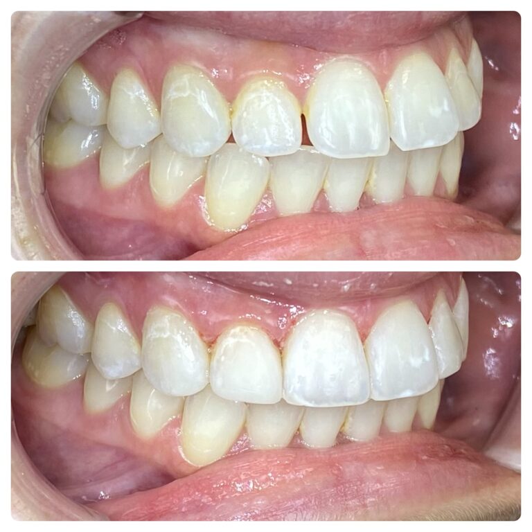 Before and After Photos Nuva Dental