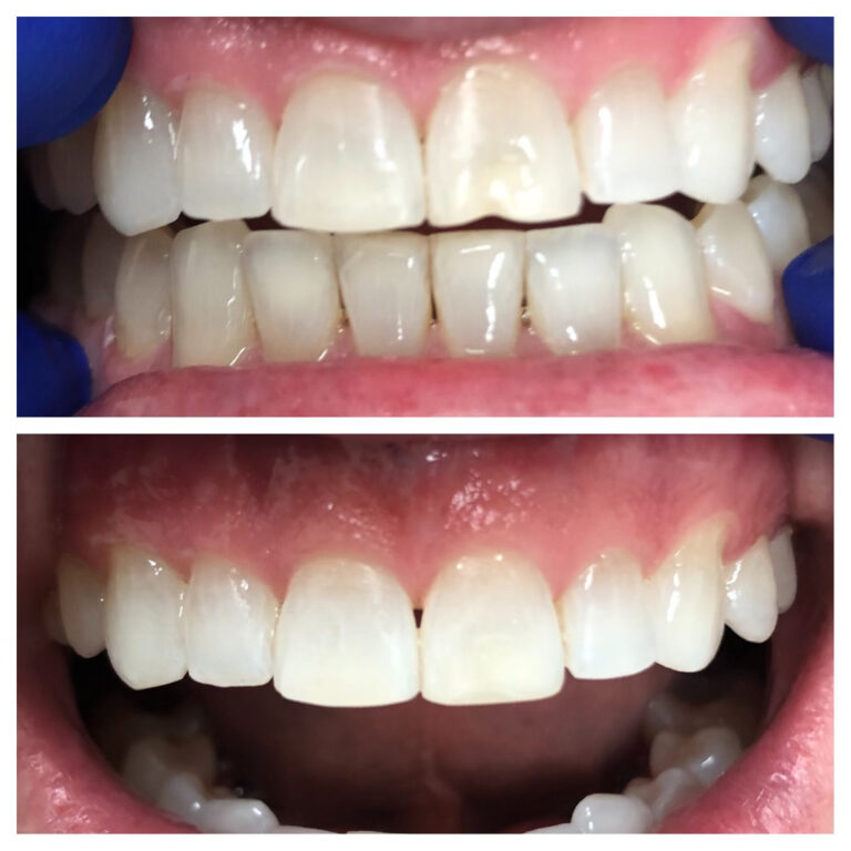 Before and After Photos Nuva Dental