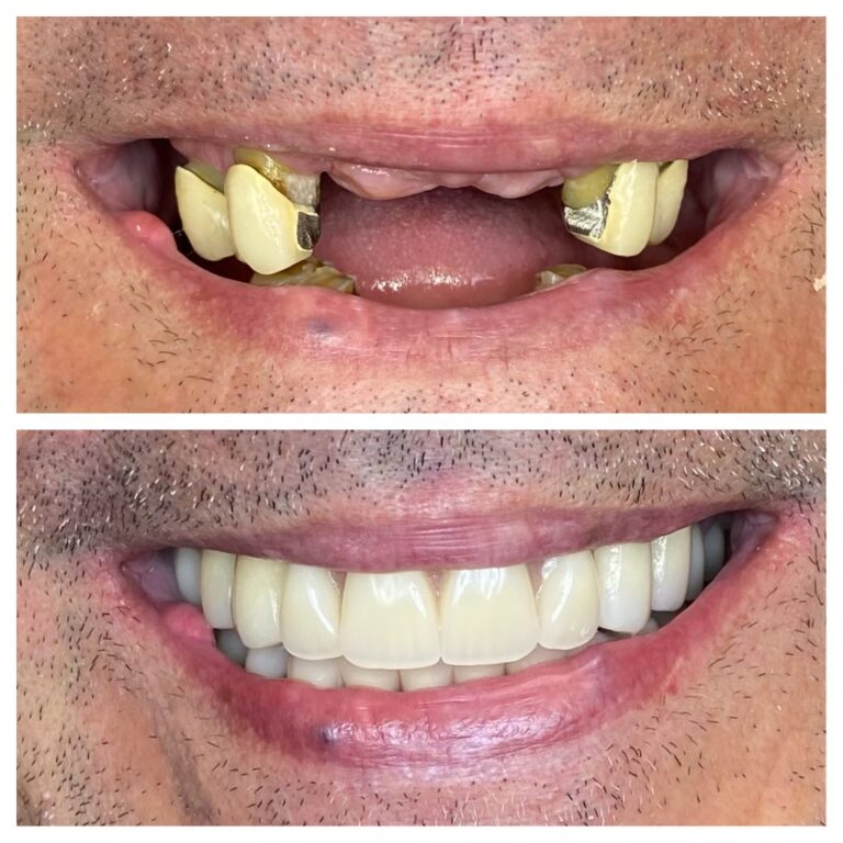 Before and After Photos Nuva Dental