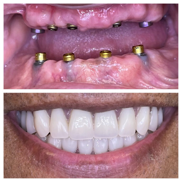 Before and After Photos Nuva Dental