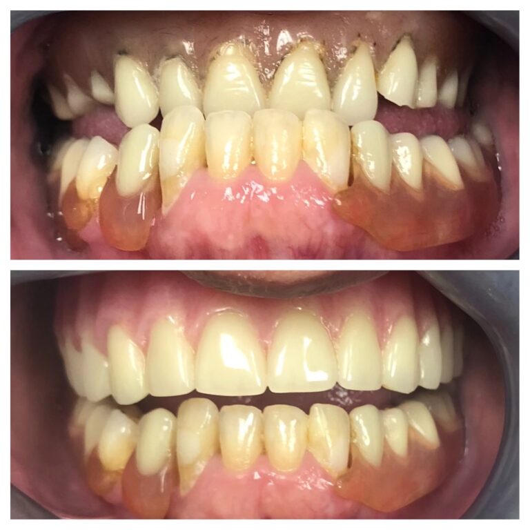 Before and After Photos Nuva Dental