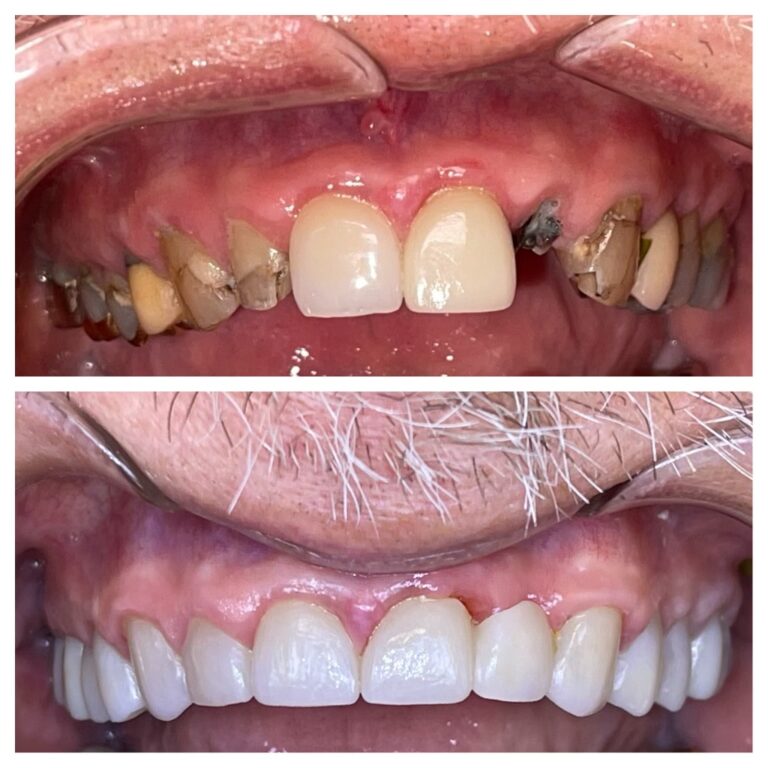 Before and After Photos Nuva Dental