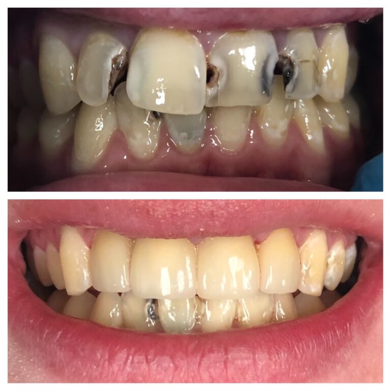 Before and After Photos Nuva Dental