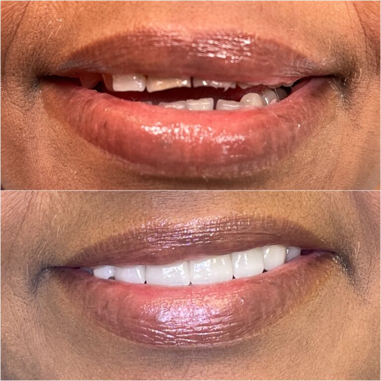 Before and After Photos Nuva Dental