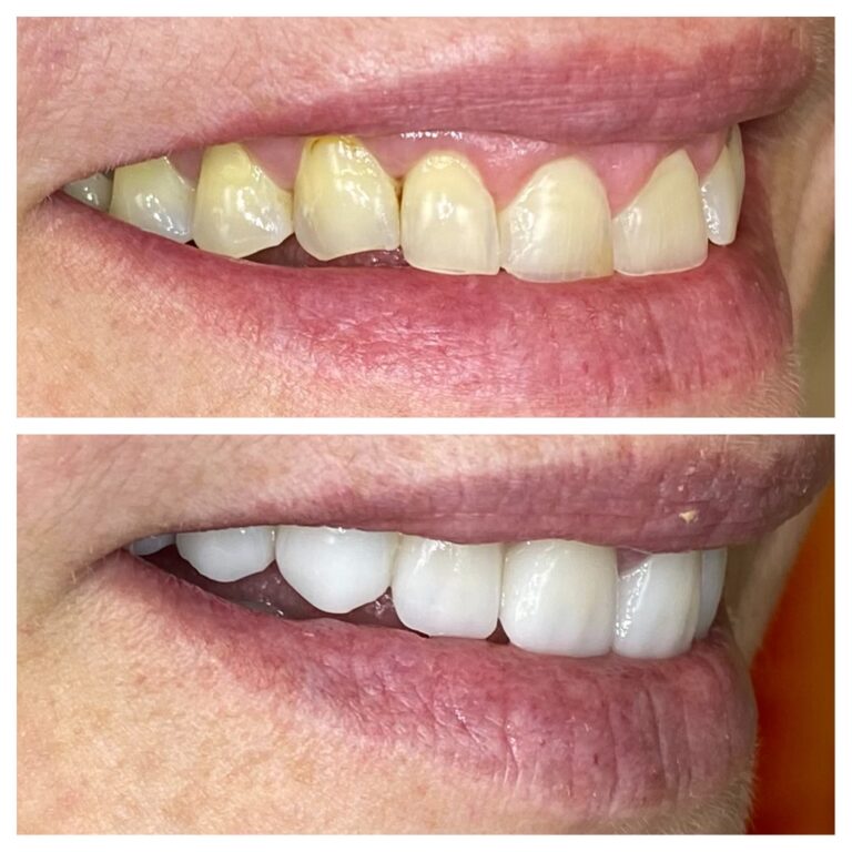 Before and After Photos Nuva Dental