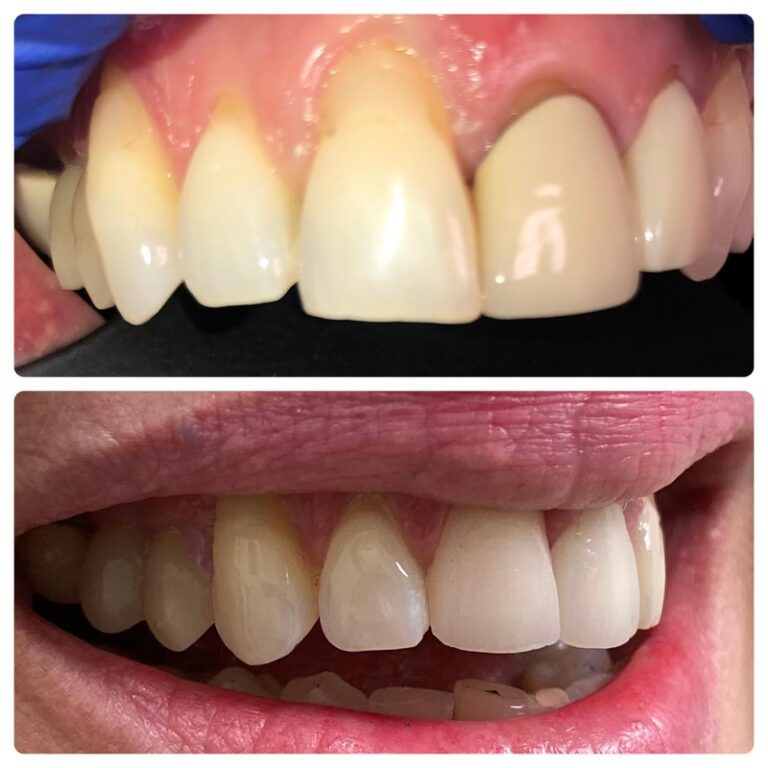 Before and After Photos Nuva Dental