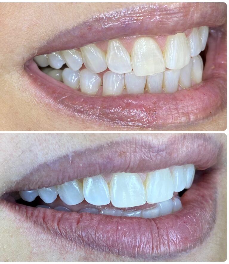 Before and After Photos Nuva Dental