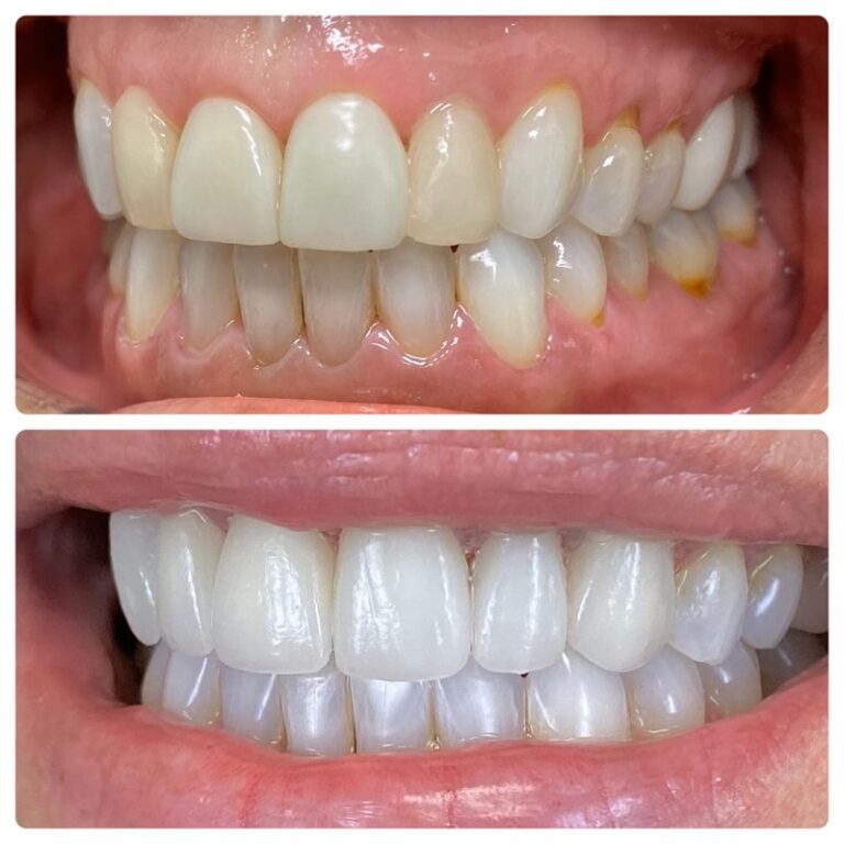 Before and After Photos Nuva Dental