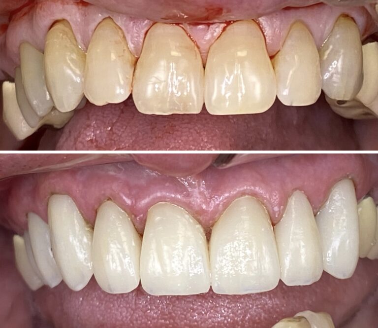 Before and After Photos Nuva Dental