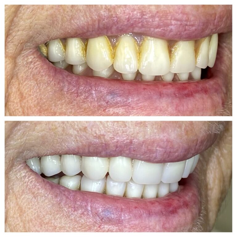 Before and After Photos Nuva Dental