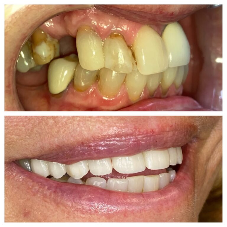 Before and After Photos Nuva Dental