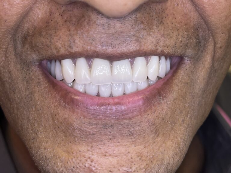 Before and After Photos Nuva Dental