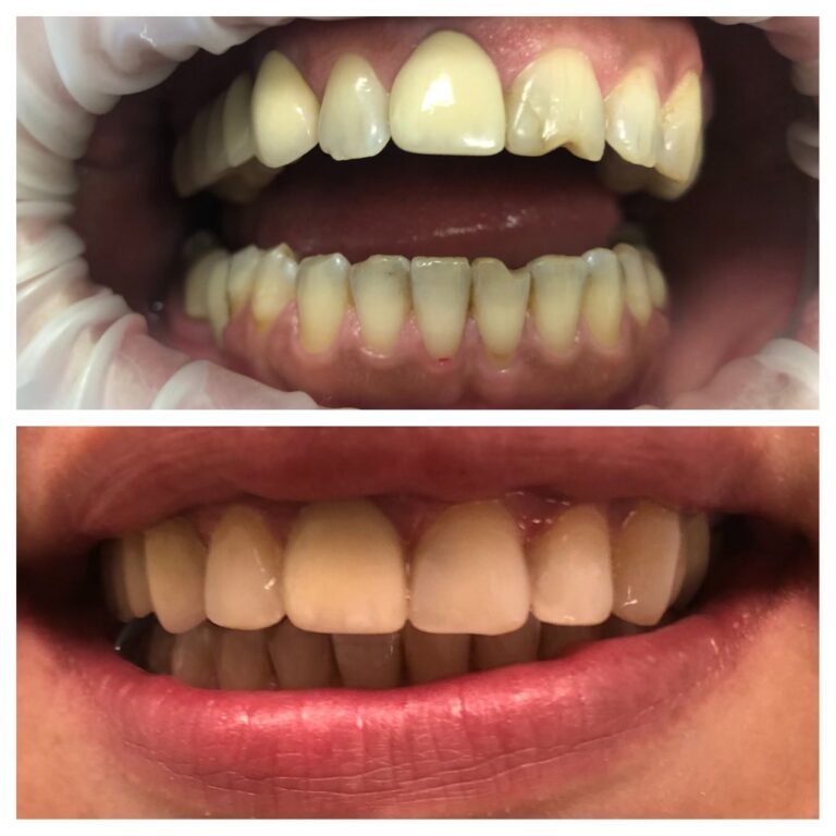 Before and After Photos Nuva Dental