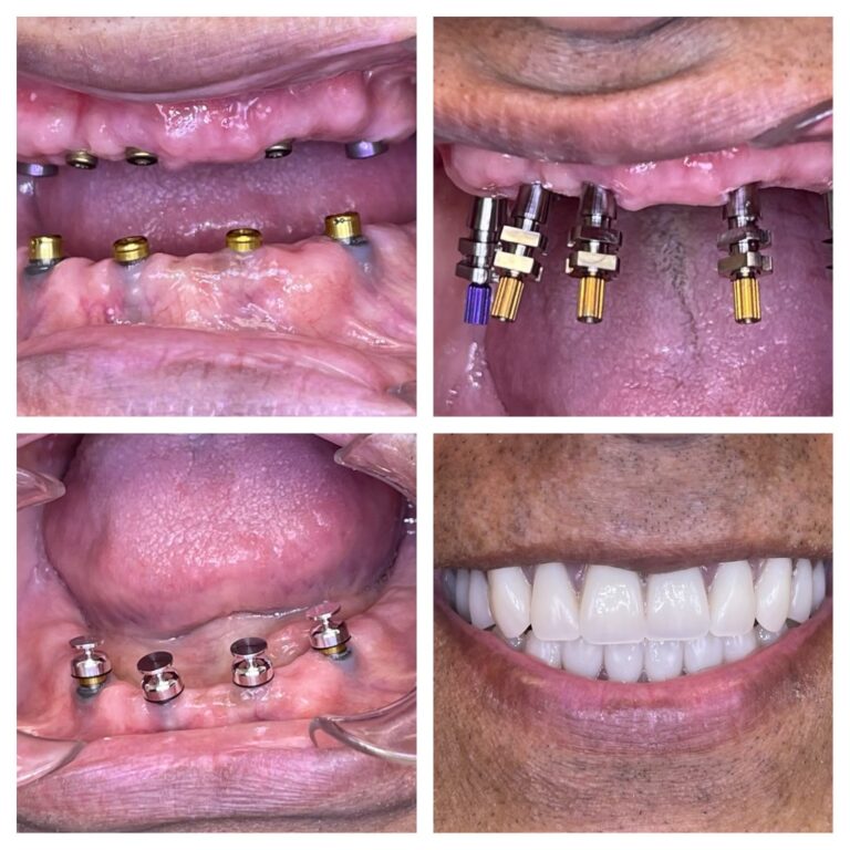 Before and After Photos Nuva Dental